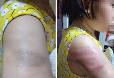 Viết bài chậm, học sinh lớp 4 bị cô giáo đánh bầm tím tay